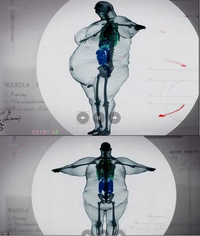 Modélisation en 3D du squellete d'un homme de 450 kg (faite à partie de radios)