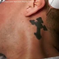Enlever un tatouage