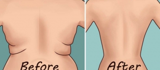 liposuccion