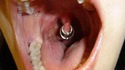 Piercing sur glotte