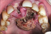 Des dents pourries