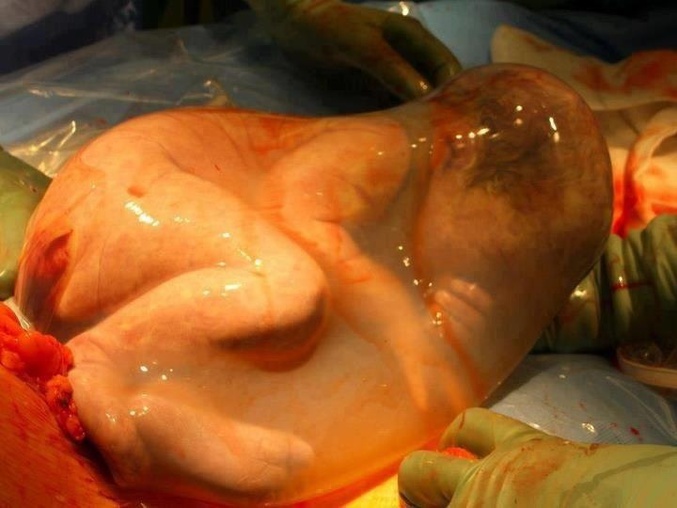 Ce bébé est né via césarienne aux USA. Il est plutôt rare que le sac amniotique soit conservé intact à l'accouchement.