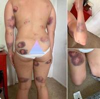 Une maman du wall of moms de Portland a reçu beaucoup d'impacts de flash-balls des policiers...