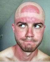 Intellectuel avec coup de soleil
