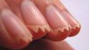 Ongles dentés