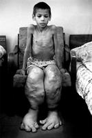 Désolant : la catastrophe de Tchernobyl entraîna des malformations terribles