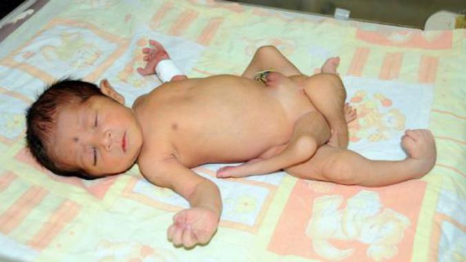 Un bébé à 6 jambes est né au Pakistan.