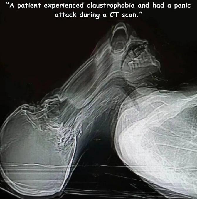 Un patient atteint de claustrophobie à eu une crise de panique pendant une tomodensitométrie (j'ai appris un mot)