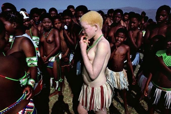 Jeune africaine albinos (La malheureuse, ça ne doit pas être facile à vivre dans certaines cultures)