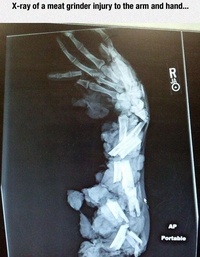 Radiographie d'un bras et d'une main passés dans un hachoir à viande