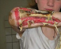 Les ravages de la drogue Krokodil