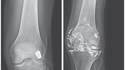 Empoisonnement au plomb à cause d'une balle dans le genou
