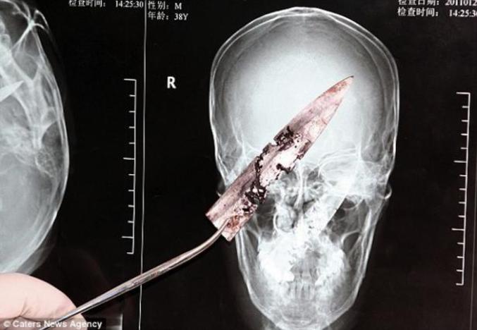 Depuis quatre ans, un Chinois se plaignait de migraines fulgurantes. Après un examen de routine, les médecins ont découvert une lame de 10 cm entièrement plantée dans son crâne. Ce Chinois s'est fait agresser au couteau en 2006.