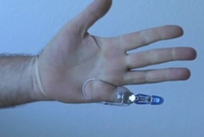 Une prothèse pour le petit doigt très minutieuse et fonctionnelle.