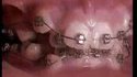 Un an et demi d'orthodontie