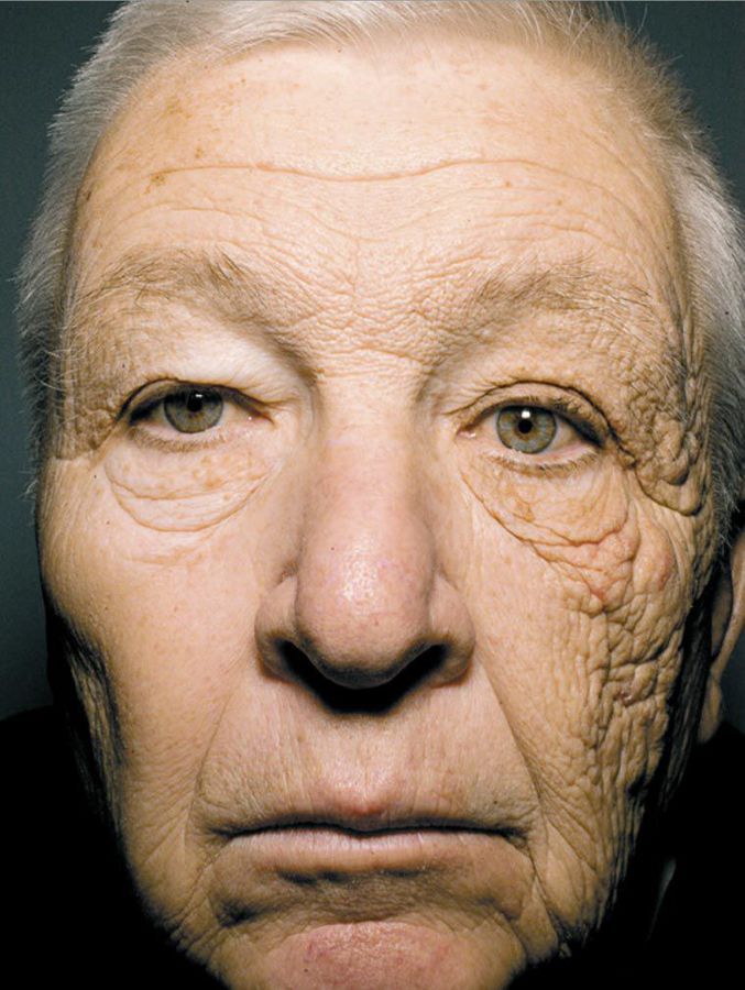 Cet homme a conduit un camion pendant 28 ans, exposant beaucoup plus le coté gauche de son visage au soleil.