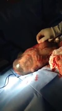 Un bébé encore dans son sac amniotique