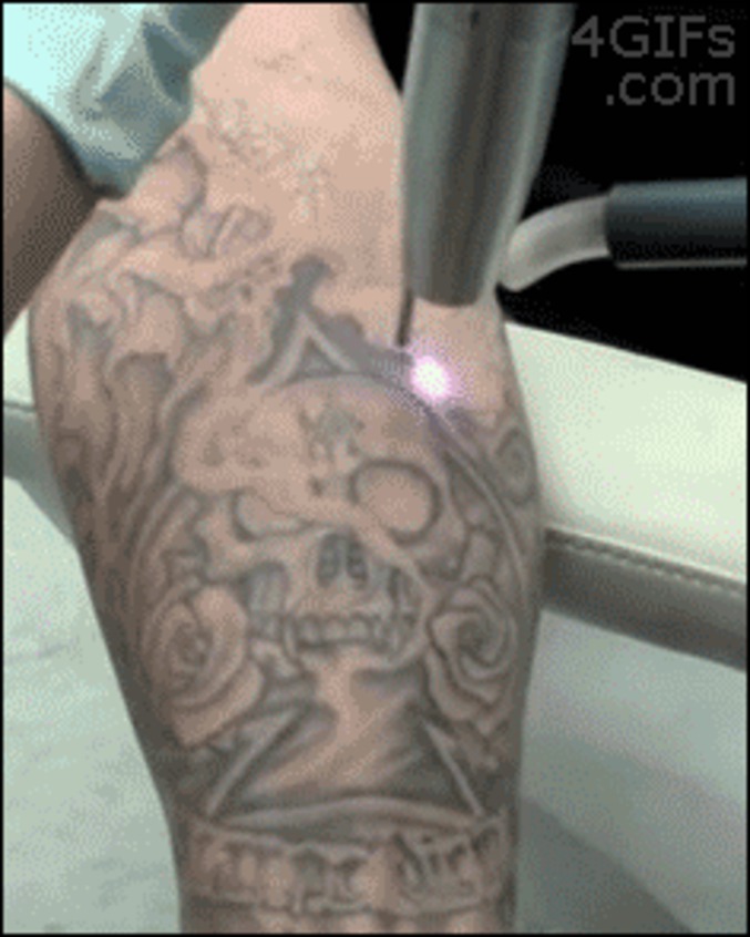 Suppression d'un tatouage au laser