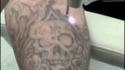 Suppression d'un tatouage au laser
