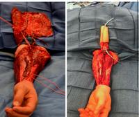 Photo de Chirurgie de réattribution sexuelle de femme vers homme.