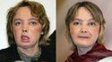 Greffe de visage