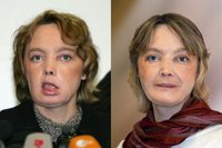 Greffe de visage