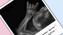 un foetus