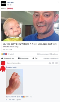 Eli, le bébé né sans nez