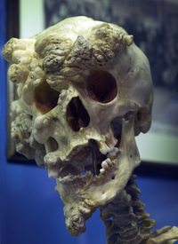 Joseph Merrick
