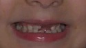 Regarde mes dents pousser