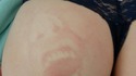Impression sur fesse
