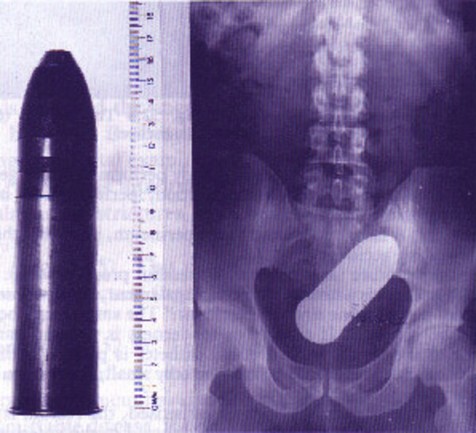 Une personne s'est enfoncée un obus via l'orifice anal.