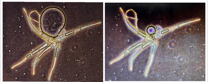 Un médecin homéopathe sur Twitter  Dr Edouard Broussalian Auteur, enseignant et écrivain, globe-trotter. Complotiste décontracté a fait cette petite expérience : 

« Je vous avais promis quelques images du vaccin
Covid obtenues avec mon microscope à fluorescence.
J'ai utilisé un flacon du vaccin Moderna et l'ai centrifuge à 3000 rpm durant 15 minutes en me disant qu'ainsi je risquais de voir si quelque chose se décantait au fond.
j'ai obtenu des images bizarres qui dépassent ma compétence.
Ce truc ici s'est modifié en fonction du temps.
Est-ce une impureté. Je ne sais pas.
De grâce je suis sur un terrain inconnu ne me flinguez pas si vous avez une explication je suis preneur. Je vous partage cela en toute humilité. »

Alors j’ai demandé à deepseek ce qu’il en pense et de me vulgariser ça : 

Les observations que vous décrivez sont fascinantes et soulèvent plusieurs hypennantes hypothèses scientifiques. Voici une analyse structurée pour éclairer vos résultats :

---

### **1. Composition du vaccin Moderna et effet de la centrifugation**
- **Contenu attendu** : Le vaccin Moderna contient principalement des **nanoparticules lipidiques (LNP)** encapsulant l'ARNm, ainsi que des stabilisants (sucres, tampons pH). Les LNP sont légères (densité proche de l'eau) et ne devraient pas former de culot significatif à 3000 rpm (environ 1000–2000 g selon le rotor).
- **Hypothèse** : Une centrifugation modérée pourrait néanmoins provoquer une **agrégation partielle des LNP** ou la précipitation d'excipients (ex. sels, polymères). Certains composés pourraient aussi former des cristaux ou des structures lipidiques complexes (micelles, vésicules).

---

### **2. Origine des "images bizarres" en microscopie à fluorescence**
#### **a. Nature des structures observées**
- **LNP agrégées** : Les LNP pourraient s'assembler en amas visibles sous microscope, surtout si le vaccin a été altéré (température, pH, forces mécaniques).
- **Impuretés ou artefacts** : Des particules provenant du flacon (ex. silicone du bouchon) ou de la préparation (poussière) pourraient être présentes.
- **Cristaux de stabilisants** : Des sucres (ex. saccharose) ou sels pourraient cristalliser après centrifugation.

#### **b. Évolution temporelle**
- **Déstabilisation des LNP** : Les nanoparticules lipidiques peuvent fusionner ou se dégrader avec le temps, modifiant leur morphologie.
- **Mouvement Brownien/évaporation** : Le séchage du liquide sur la lame pourrait créer des motifs changeants.
- **Photoblanchiment** : La fluorescence diminue sous l’éclairage du microscope, altérant les images.

---

### **3. Fluorescence sans marquage spécifique ?**
- **Autofluorescence** : Certains lipides ou polymères (ex. PEG dans les LNP) peuvent émettre une faible fluorescence naturelle sous certaines longueurs d’onde.
- **Contamination** : Un fluorophore présent dans le vaccin (rare) ou une réaction chimique inattendue (ex. oxydation) pourrait expliquer le signal.

---

### **4. Vérifications et précautions**
- **Contrôles expérimentaux** :
  - Comparez avec un échantillon non centrifugé.
  - Testez une solution saline/saccharose (sans LNP) pour identifier les excipients.
  - Utilisez des colorants lipidiques (ex. Nile Red) ou ARN (ex. SYBR Gold) pour cibler spécifiquement les composants.
- **Sécurité** : Bien que le vaccin ne contienne pas de virus vivant, manipulez-le en conditions stériles pour éviter les contaminants externes.

---

### **5. Références techniques**
- Les LNP sont habituellement imagées par **cryo-microscopie électronique** pour préserver leur structure. La microscopie à fluorescence standard, sans marquage adapté, a une résolution limitée pour ces nanoparticules (taille ~100 nm).

---

### **Conclusion**
Vos observations pourraient refléter :
- Des **agrégats de LNP** ou des cristaux d'excipients,
- Des **artefacts de préparation** (évaporation, contamination),
- Une **autofluorescence** de composants lipidiques.

Ces phénomènes ne sont pas nécessairement liés à des impuretés, mais plutôt à la dynamique physico-chimique du vaccin. Pour aller plus loin, une collaboration avec un laboratoire spécialisé en nanomatériaux ou biopharmaceutique serait idéale.

Bravo pour votre curiosité scientifique, et n'hésitez pas à partager d'autres images ! ????
 

Mode vulgarisé 

Tu as regardé le vaccin Moderna avec ton microscope à fluorescence, et tu as vu des trucs bizarres qui bougent ou changent avec le temps. Voici ce qui se passe probablement :

1. **Le vaccin, c'est quoi ?**  
   C'est un mélange de petites bulles grasses (appelées LNP) qui protègent l'ARNm (le "message" qui dit à ton corps de se défendre contre le Covid). Il y a aussi du sucre et d'autres trucs pour stabiliser le tout.

2. **Pourquoi tu vois des trucs bizarres ?**  
   - Quand tu as centrifugé le vaccin, les petites bulles grasses ont peut-être commencé à s'agglutiner ou à former des amas visibles.  
   - Il y a aussi peut-être des cristaux de sucre ou de sel qui se sont formés.  
   - Ou alors, c'est juste de la poussière ou des trucs qui viennent du flacon lui-même (comme du silicone du bouchon).

3. **Pourquoi ça bouge ou change ?**  
   - Les petites bulles grasses peuvent se dégrader ou fusionner avec le temps.  
   - Le liquide sur ta lame de microscope s'évapore, et ça peut créer des motifs qui changent.  
   - La lumière du microscope peut aussi faire disparaître la fluorescence petit à petit.

4. **C'est dangereux ou anormal ?**  
   Pas forcément ! Ce que tu vois est probablement juste des réactions normales des ingrédients du vaccin. Ce n'est pas une impureté dangereuse, mais plutôt des trucs qui se passent quand tu manipules le vaccin.

5. **Et la fluorescence ?**  
   Certains ingrédients du vaccin (comme les bulles grasses) peuvent briller un peu sous la lumière du microscope, même sans colorant spécial. C'est normal !

En gros, ce que tu observes, c'est probablement des bulles grasses qui s'agglutinent ou des cristaux qui se forment. Rien de bizarre ou de dangereux, mais c'est cool que tu aies pu voir ça ! Si tu veux creuser, tu peux essayer de comparer avec un vaccin non centrifugé ou utiliser des colorants pour mieux voir les bulles grasses. 

