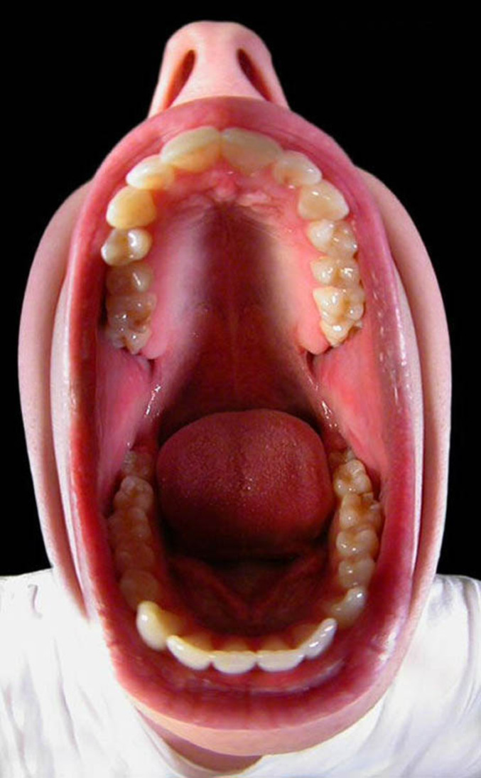 V1 Dents pourries