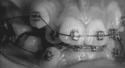 Redressement des dents