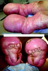 Les chevilles (et pieds) qui enflent?