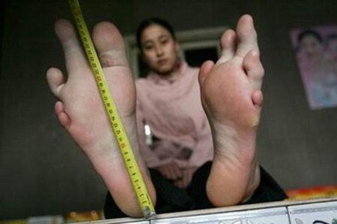 Une jeune fille aux orteils disposés de façon étrange