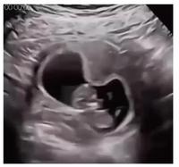 Le bébé a le hoquet 