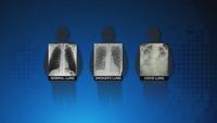 Comparaison poumons sains, de fumeur et de malade du covid