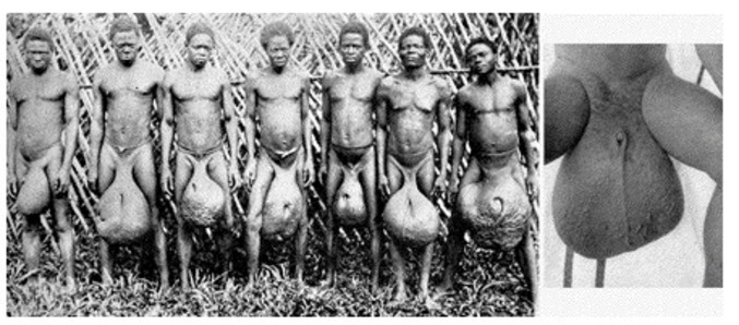 Des africains qui souffrent d'une maladie des testicules
