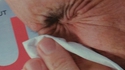 Se torcher l'anus