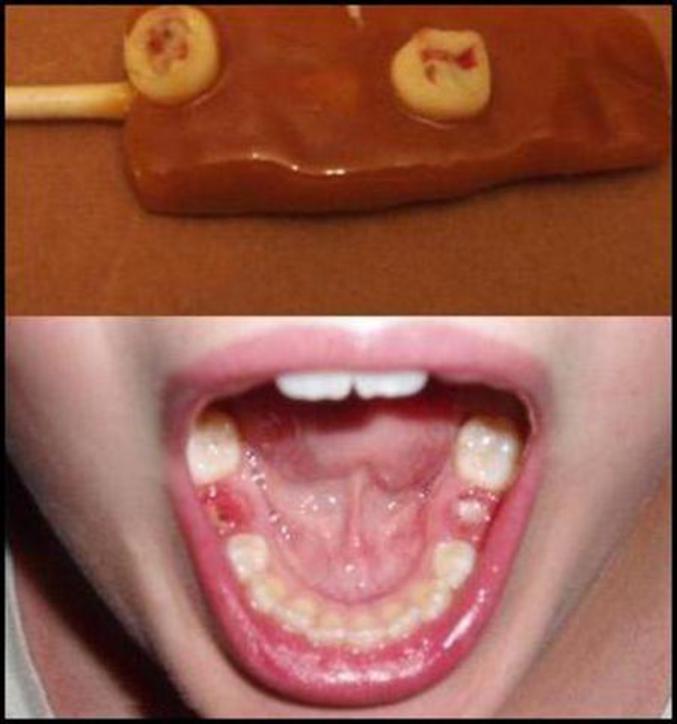 Le sucre est mauvais pour les dents.