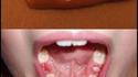 Anti-dents de lait