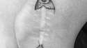 Récup' de cicatrice avec un tatouage
