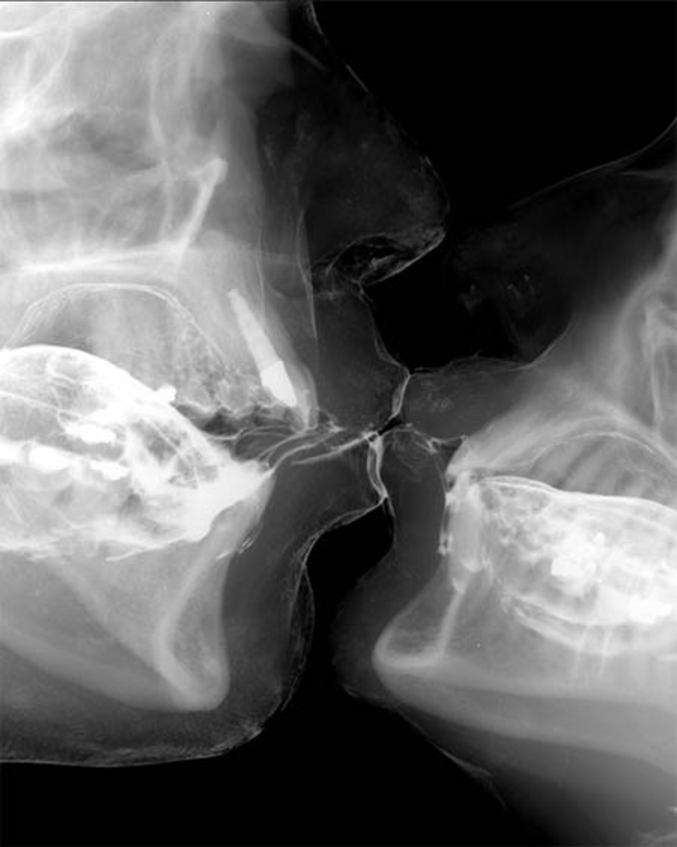 Un baiser aux rayons X.