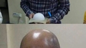 Tenso crânien