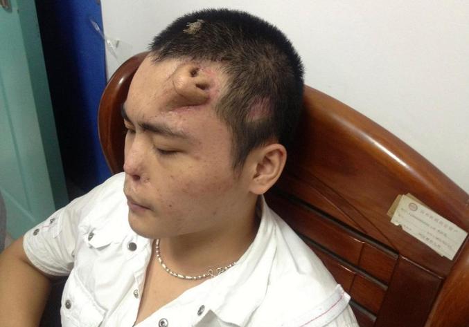 Ce Chinois de 22 ans a perdu une grosse partie de son nez lors d'un accident de voiture en 2012. Des médecins de l'hôpital de Fuzhou (en Chine) lui ont refait un nez grâce au cartilage de ses côtes et des extenseurs de tissu. Son nouveau nez devrait prochainement prendre place au milieu du visage.