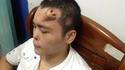 Un Chinois de 22 ans a un nez qui lui pousse sur le front