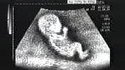 Echographie d'un futur champion