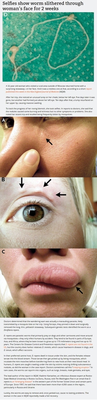 Un ver se balade sur un visage pendant 2 semaines